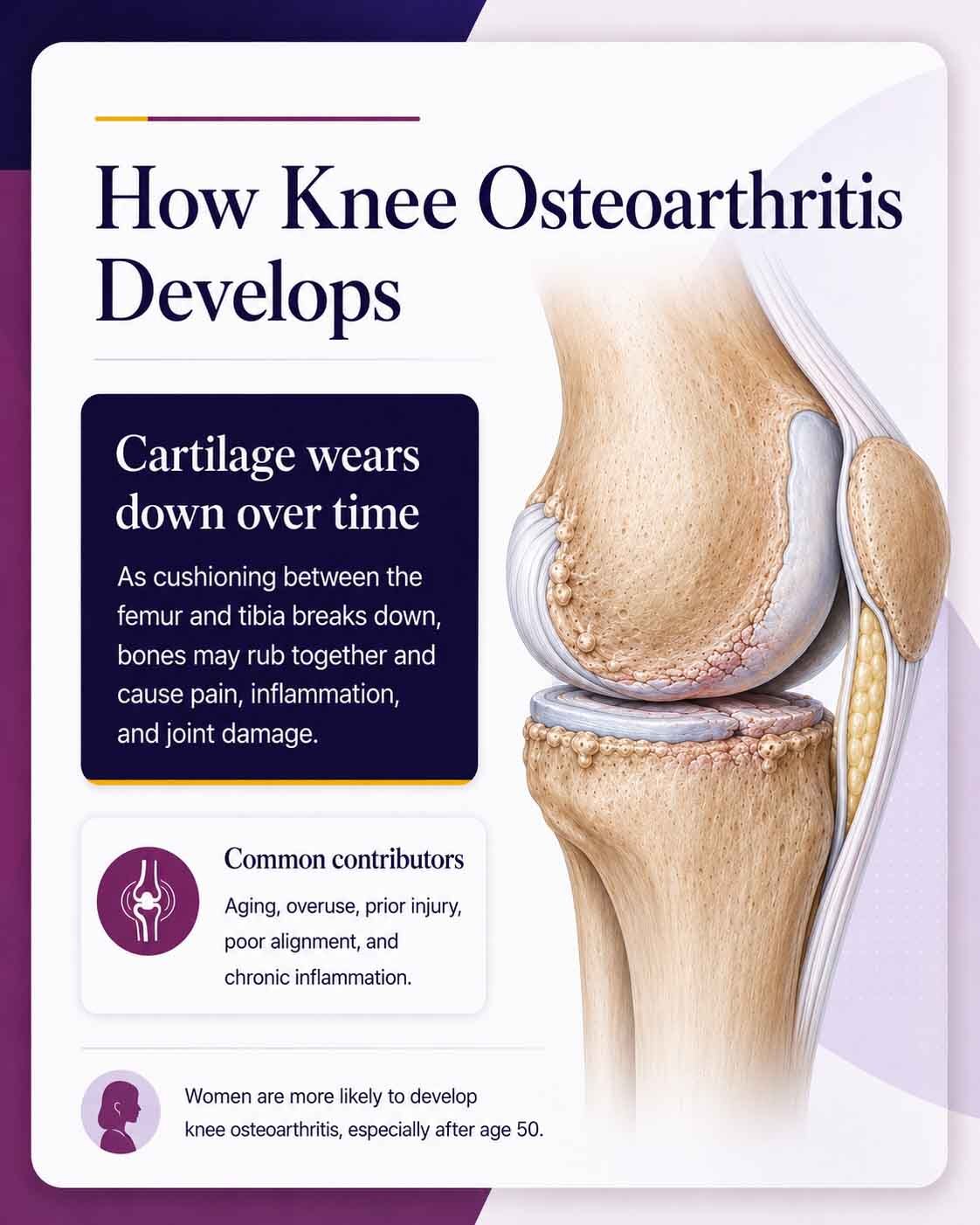 Astra Knee Pain Center Knee Osteoarthritis Development