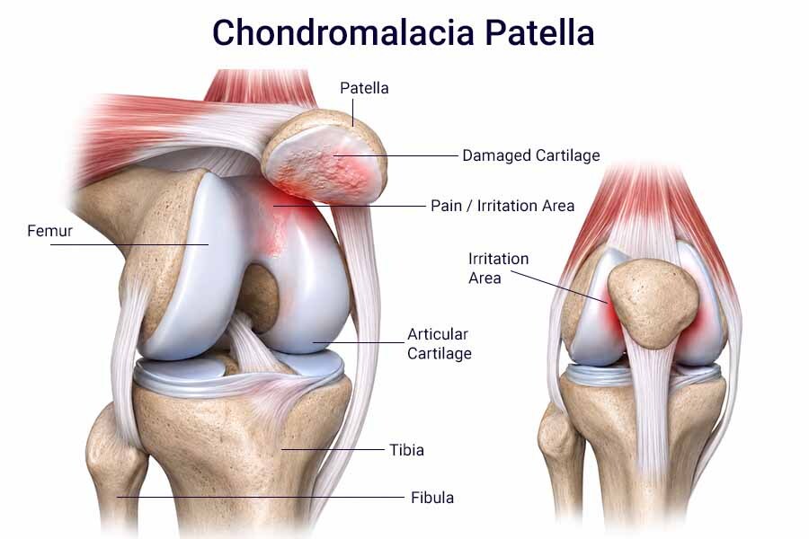 Medical illustration of chondromalacia patella showing damaged cartilage under the kneecap, femoral groove irritation, and anterior knee pain.