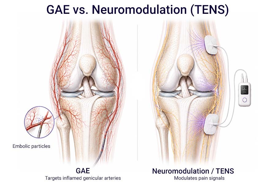 GAE vs TENS neuromodulation illustration showing genicular artery embolization targeting inflamed knee arteries and TENS therapy modulating pain signals.