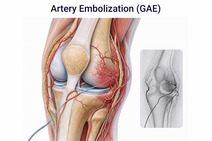 Medical illustration showing knee anatomy and genicular arteries involved in genicular artery embolization.