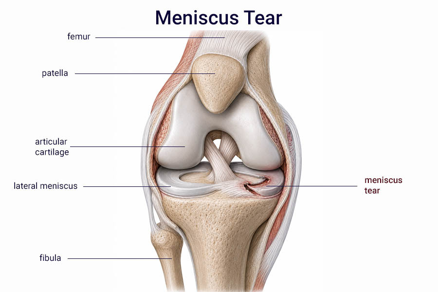 Meniscus tear knee anatomy illustration showing the femur, patella, articular cartilage, lateral meniscus, fibula, and a torn medial meniscus.