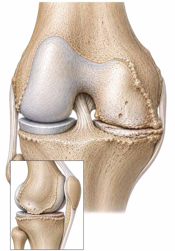 Osteoarthritis of The Knee Anatomy Illustration