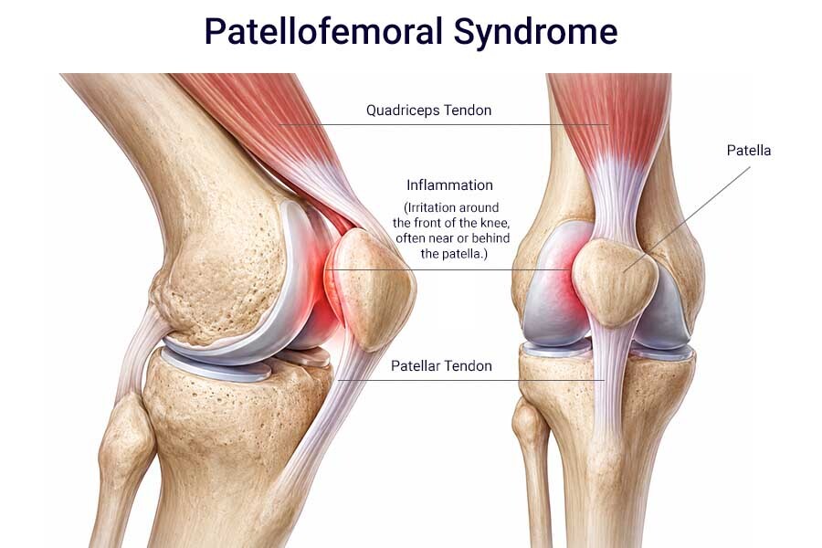 Patellofemoral syndrome illustration showing pain behind the kneecap, patellar maltracking, and inflammation in the front of the knee.