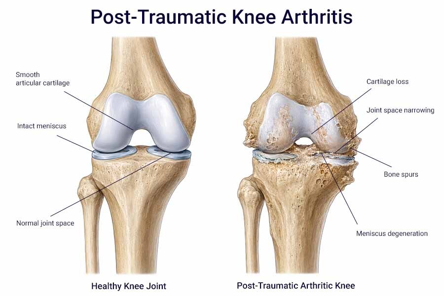 Post-traumatic knee arthritis illustration showing cartilage loss, joint space narrowing, bone spurs, and meniscus damage after knee injury in Brooklyn, NY.