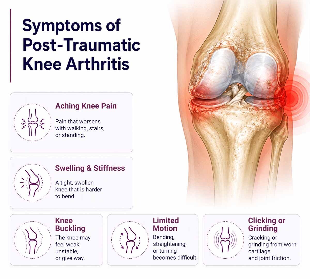 Infographic showing symptoms of post-traumatic knee arthritis with knee pain, swelling, buckling, limited motion, and clicking or grinding from joint damage.