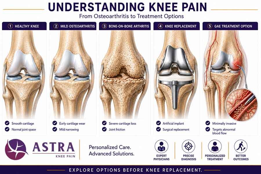 Infographic showing knee osteoarthritis progression from healthy knee to bone-on-bone arthritis, knee replacement, and genicular artery embolization as a minimally invasive treatment option.
