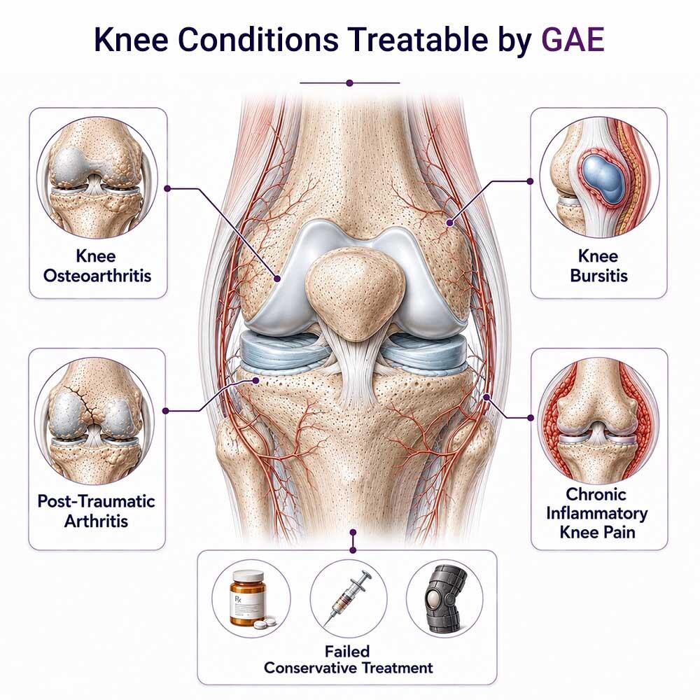 Medical illustration showing knee conditions treatable by genicular artery embolization, including knee osteoarthritis, bursitis, post-traumatic arthritis, and chronic inflammatory knee pain